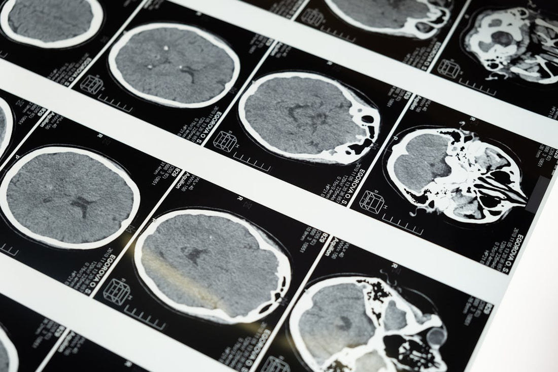MRI brain scan images displayed on a lightbox for neurological assessment