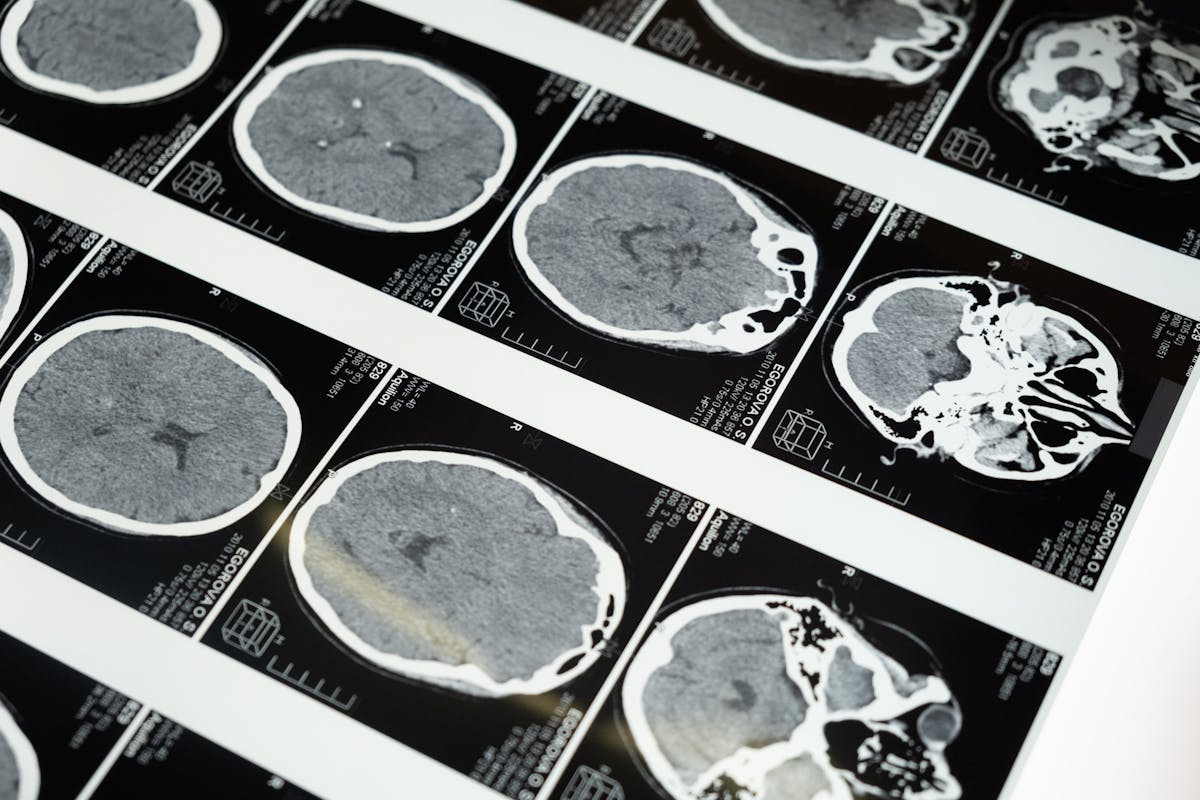 MRI brain scan images displayed on a lightbox for neurological assessment